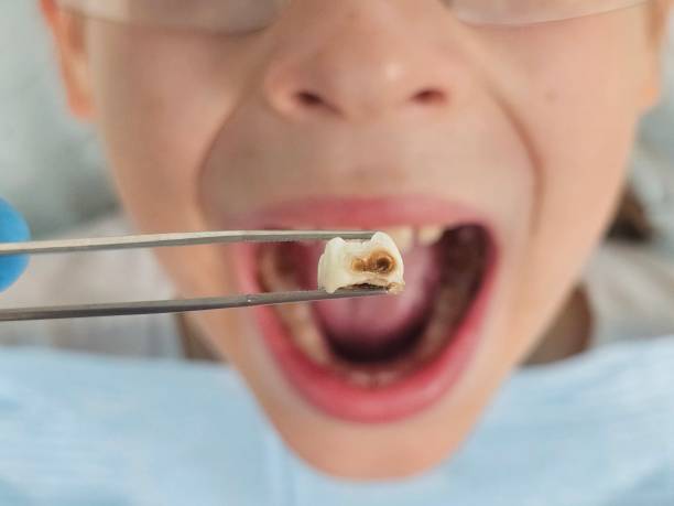 Best Knocked-Out Tooth (Avulsed Tooth) Treatment in Westland, MI